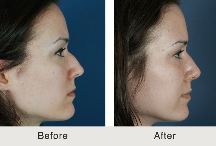 plastic surgeon rhinoplasty