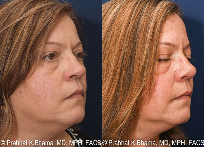 plastic surgeon rhinoplasty