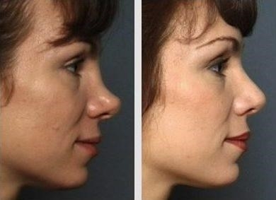 rhinoplasty expert